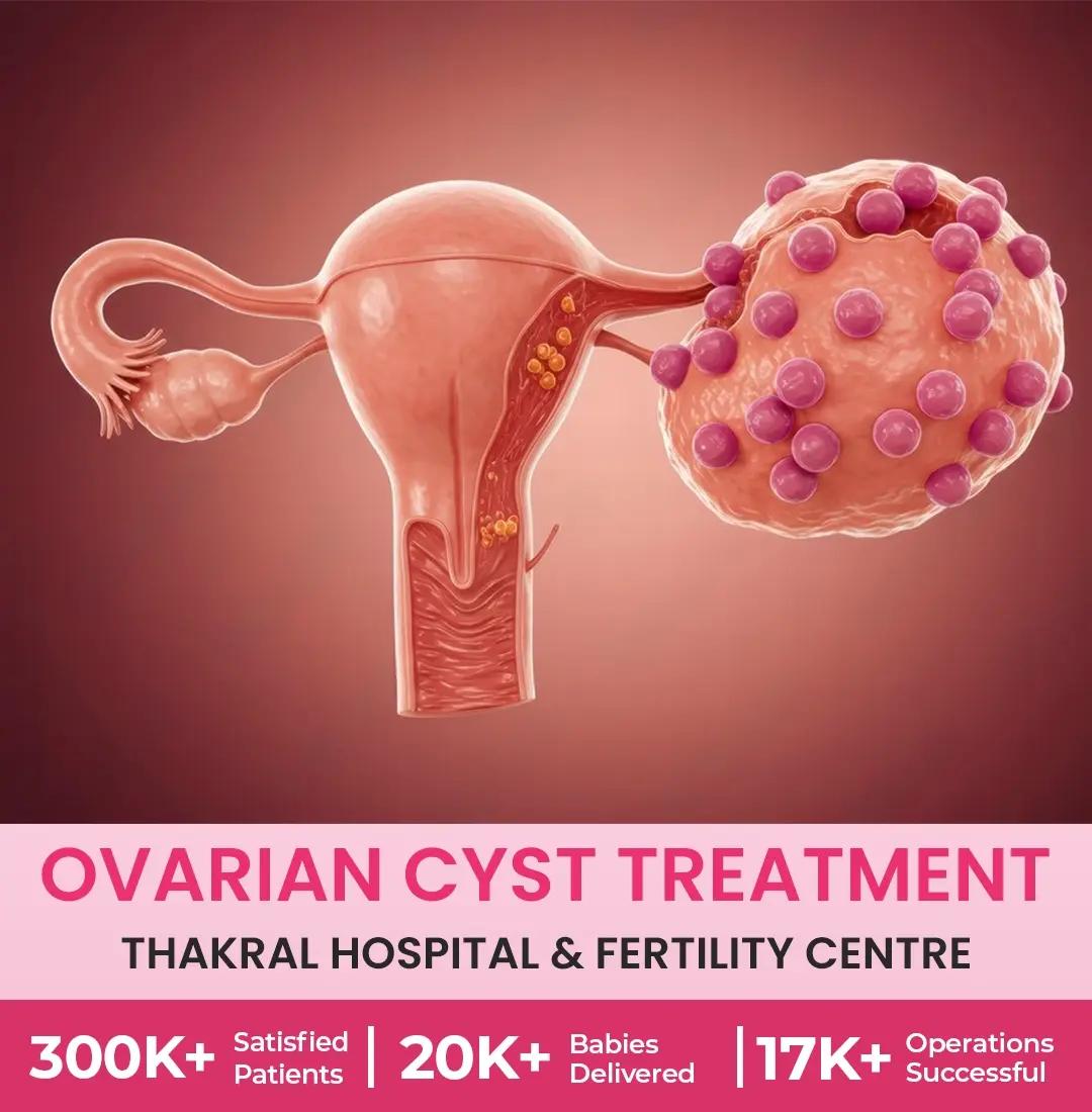 Ovarian Cyst Treatment Hospital in Gurgaon - Thakral Hospital