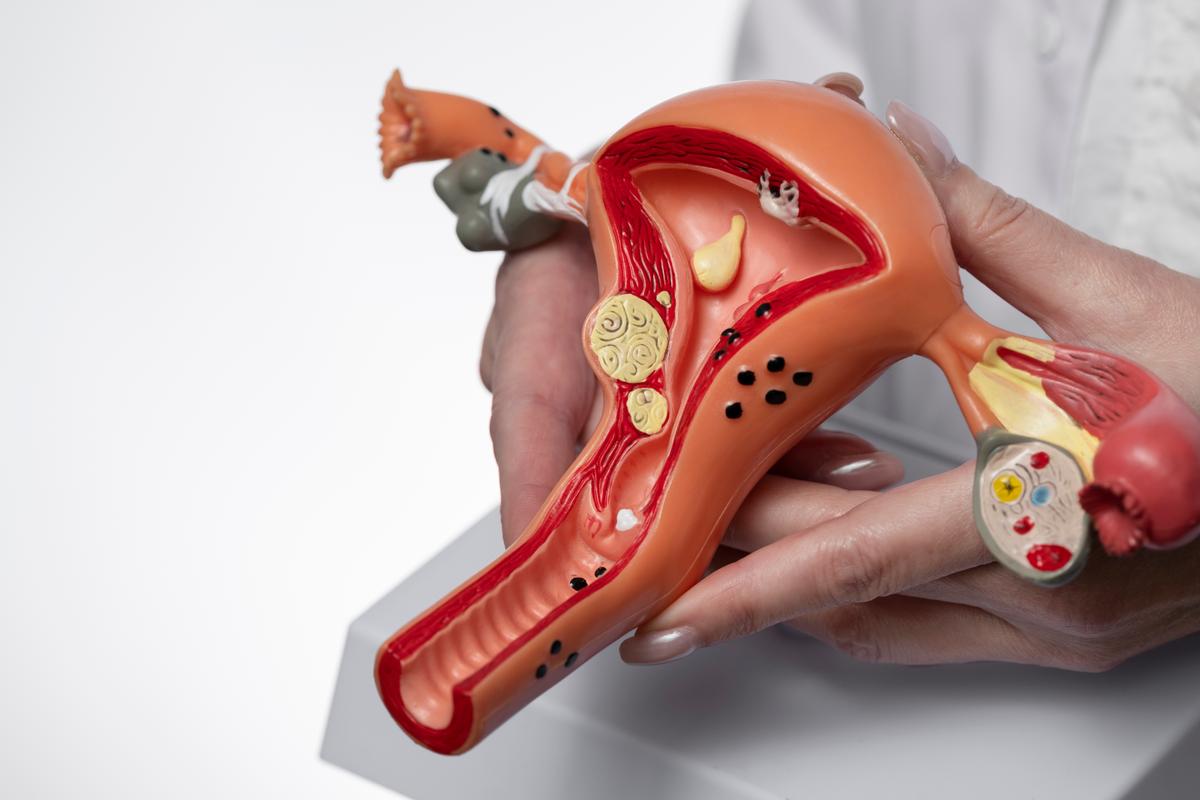 Uterine Fibroids Illustration