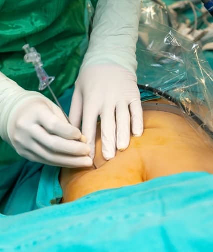 Laparoscopic Ovarian Cystectomy at Thakral Hospital