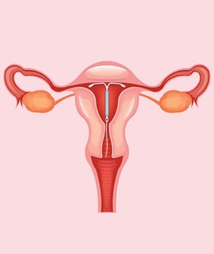 Intrauterine Contraceptive Device (IUCD)