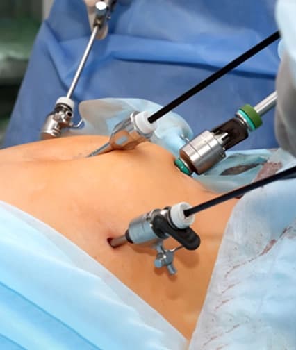 Laparoscopic hysterectomy surgery illustration