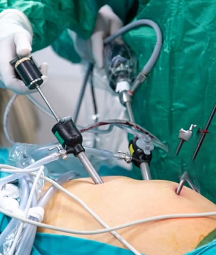Laparoscopic Myomectomy doctor in Gurgaon