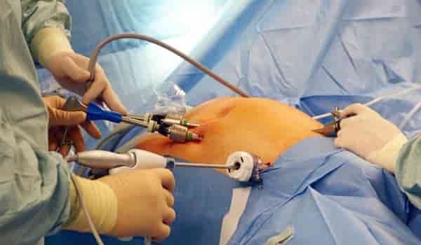 gynae-laproscopic-surgery-by-dr.-neeru-thakral